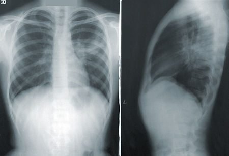 Radiografia de tórax em frente e perfil
