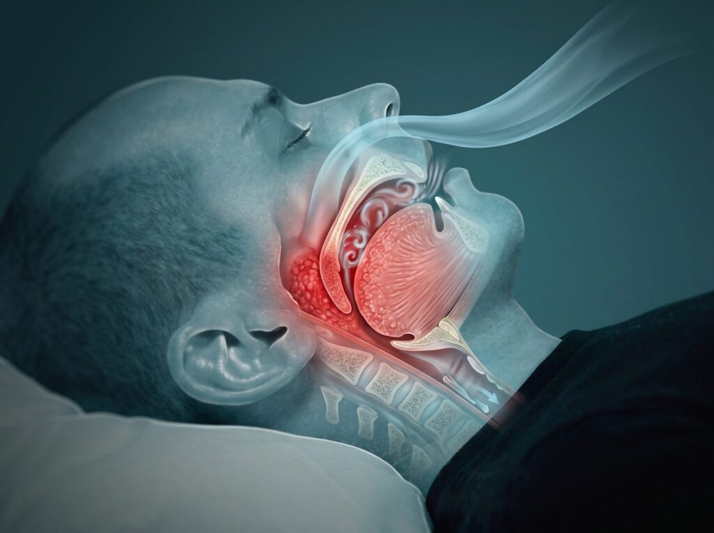 Ilustração de homem dormindo de barriga para cima, com corte anatômico mostrando o ar passando pelo nariz e a garganta estreitada